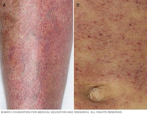 skin disease low leg adult
